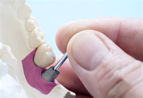 Implantes Dentales En Getxo Recupera Tu Sonrisa Con Cl Nica Dental