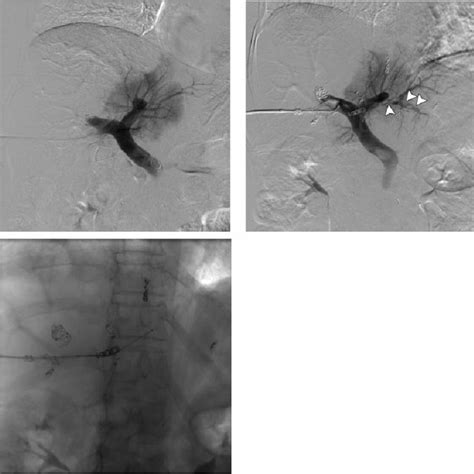 A Portal Venogram Anteroposterior AP Projection Performed From The