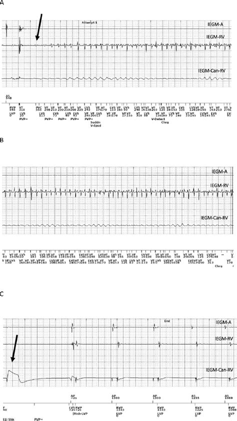 The Episode Of VF From ICD Intracardiac Electrogram A The Arrhythmia