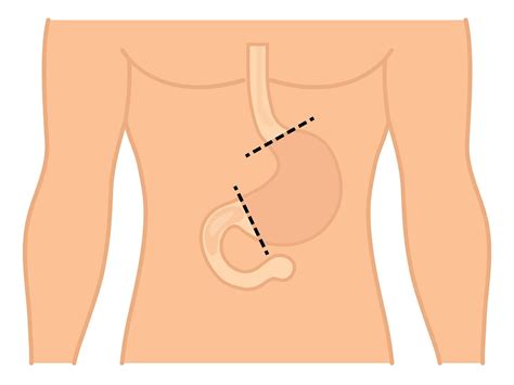 Total Gastrectomy For Stomach Cancer