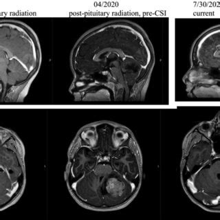 A Pre Operative MRI Brain Axial B Post Operative MRI Brain Axial C