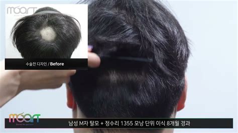 모발이식 결과 남성 M자 탈모 정수리 1355모낭 단위 이식 8개월 수술결과 빗질영상 모발이식 모발이식후기 Youtube