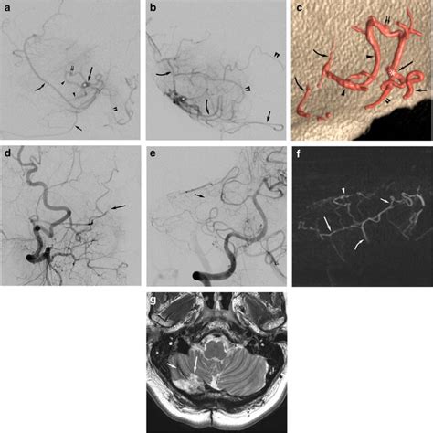 A B Superselective Injection In Frontal A And Lateral B Views