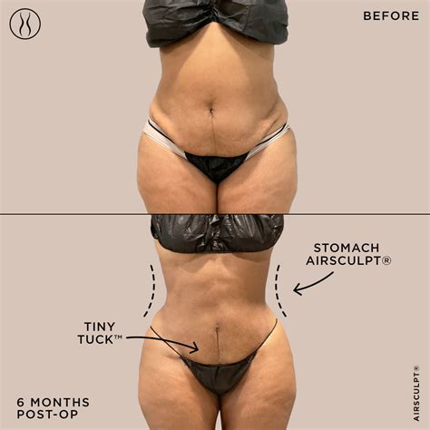 Less Invasive Alternatives To The Traditional Tummy Tuck