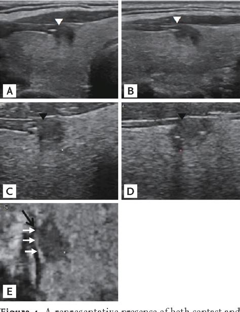 Figure 1 From Comparison Of Two And Three Dimensional Sonography For The Prediction Of The