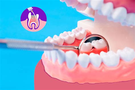 Qué es una Endodoncia y en qué consiste