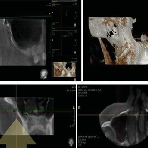 Pdf A Diagnosis Of Maxillary Sinus Fracture With Cone Beam Ct Case