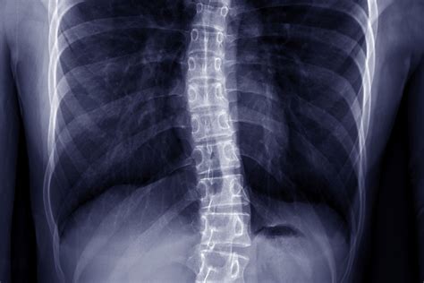 What Is Thoracolumbar Scoliosis?