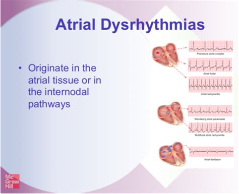 Atrial Dysrhythmias Flashcards Quizlet