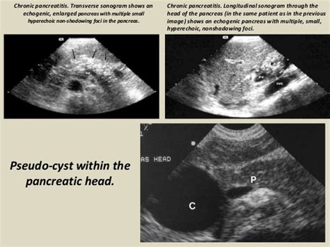 Ultrasound Of Pancrease In Radiology