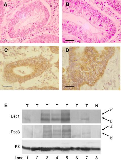 De Novo Expression Of Dsc1 And Dsc3 In Sporadic Colorectal Cancer Dsc1