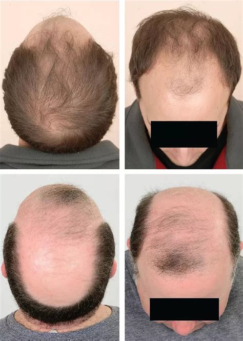 Male And Female Pattern Hair Loss A Guide To Clinical Presentations