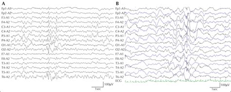 JLE Epileptic Disorders Clinical Features And Electroclinical