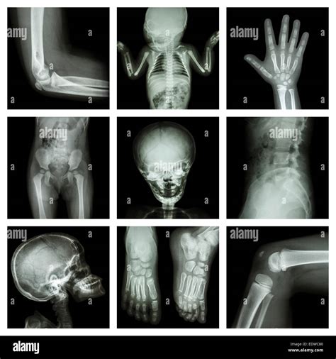 Infant X Ray High Resolution Stock Photography And Images Alamy