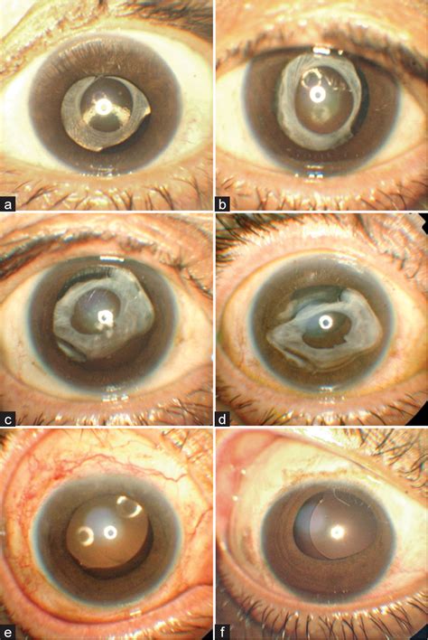 Bilateral Spontaneous Late Anterior Dislocation Of In The Bag