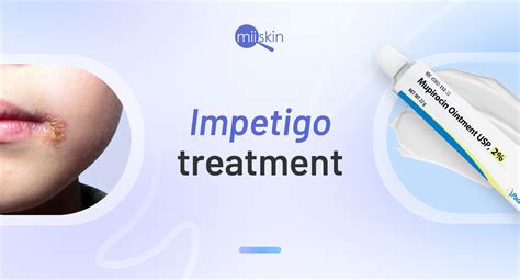 Impetigo treatment cream: Get an online prescription