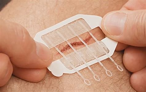 Zip Stitch Sutures X Inches Zipstitch Laceration Closures Kit Bandages