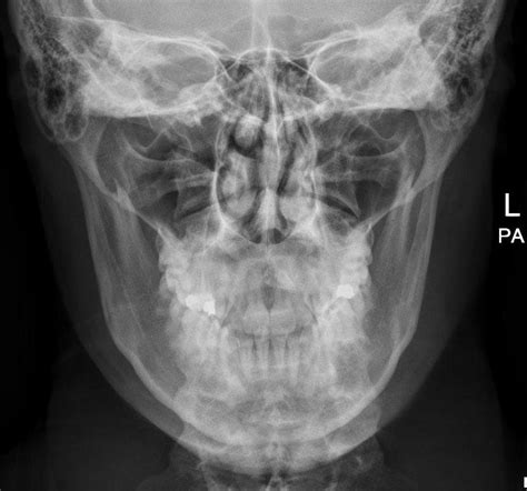 Radiography Iv Mandible Pa Diagram Quizlet