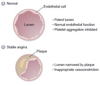 Etiology Of Angina Pharma 2 Flashcards Quizlet