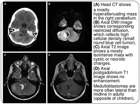 Adult Brain Tumors Imaging