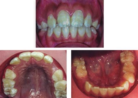 Initial Views A Intraoral Frontal View B Intraoral View Of The