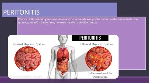 Peritonitis