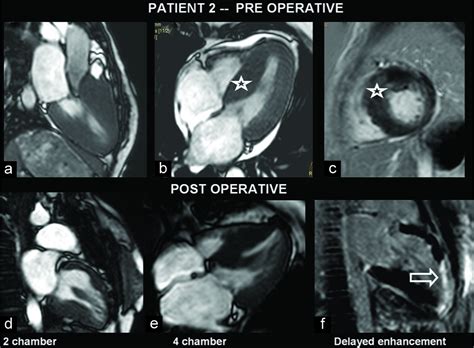 Magnetic Resonance Imaging Assessment Of Pre And Post Surgery