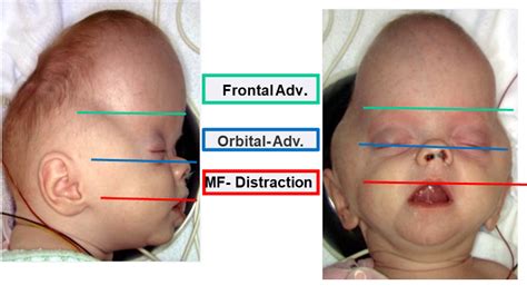 Figure 1 From Fronto Orbito Nasal Advancement A Surgical Approach Based