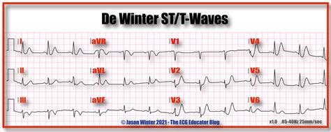 ECG Educator Blog : De Winters T waves