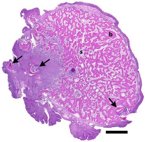 Odontoma Histology