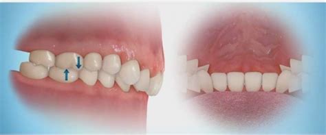 Overjet Vs Overbite How Are They Different