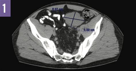 Unicentric Castleman Disease Consultant