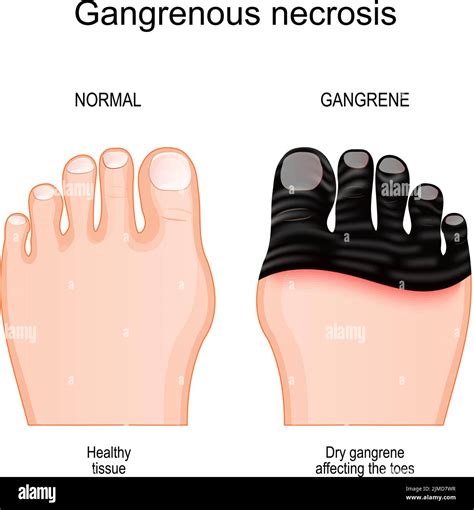 Gangrene Comparison And Difference Between Healthy Foot And Leg With