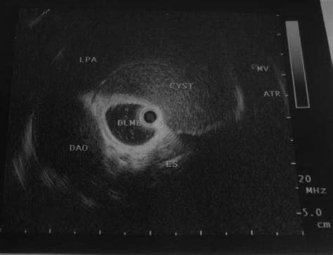 Endobronchial Ultrasound A Useful Tool In The Diagnosis Of