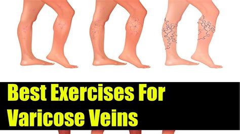 Best Exercise For Varicose Veins Exercise For Varicose Veins Youtube