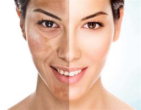 Melasma Manchas De Pele Dermapro Clinic