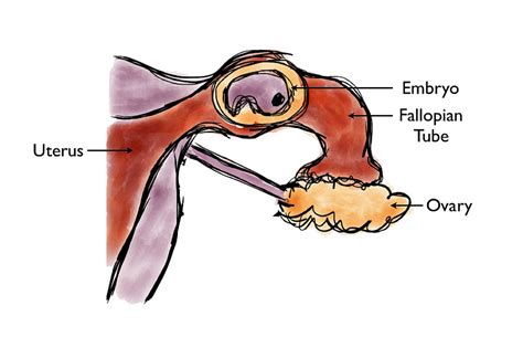 The Ivf Specialists Blog For Ivf Patients Ectopic Tubal Pregnancy