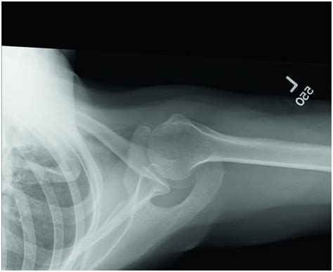 Chapter 1 Shoulder Musculoskeletal Key