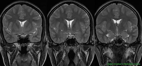 Dr Balaji Anvekar Frcr Isolated Sagging Of Frontal Lobe