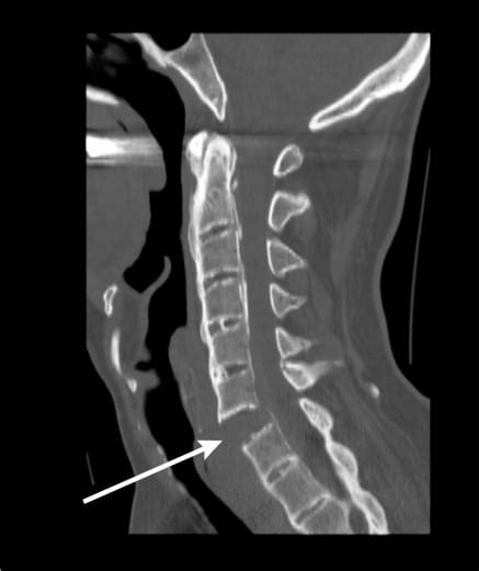 Cervical Ankylosing Spondylitis X Ray