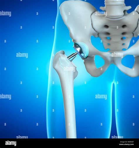 Hip Replacement Illustration Stock Photo Alamy