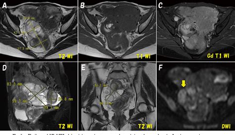 Figure 2 From A Case Of Polypoid Endometriosis Mimicking Advanced