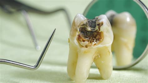 Black Teeth Causes And Treatment At Spring Orchid Dental