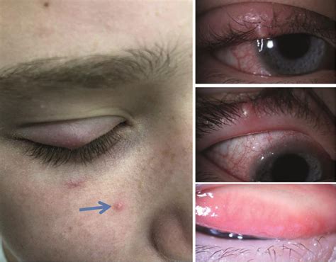 Shingles In Eyes Contagious Doctorvisit