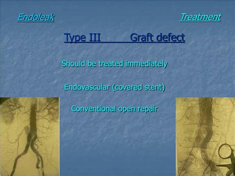 endoleak powerpoint    id
