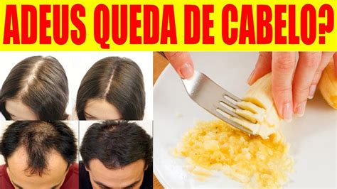 Queda De Cabelo Conhe A Esse Poderoso E Simples Rem Dio Caseiro Para