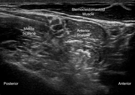 Ultrasound View Of Interscalene Nerve Block Depicting Orientation Of