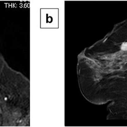 Magnetic Resonance Imaging Findings Contrast Enhanced Magnetic