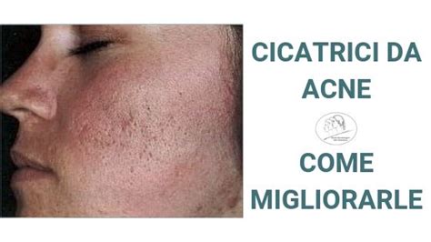 Cicatrici Da Acne L Acne Un Importante E Frequente Malattia Della