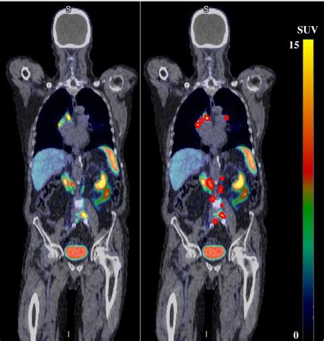 Ga Ga Psma Pet Ct European